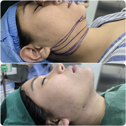 Double chin lipo