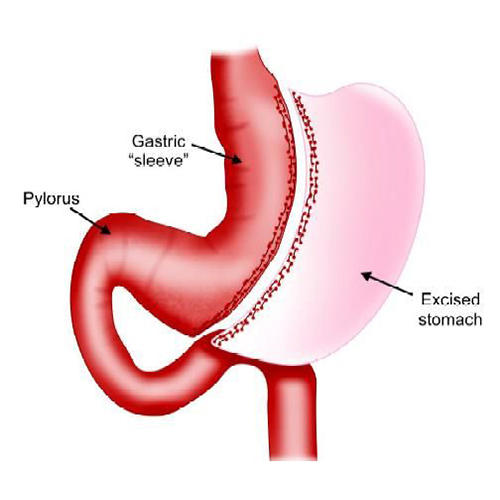 Sleeve gastrectomy