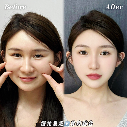 Stiff face repair